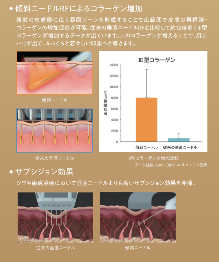 傾斜ニードルRFによるコラーゲン増加、サブシジョン効果が期待できます。
